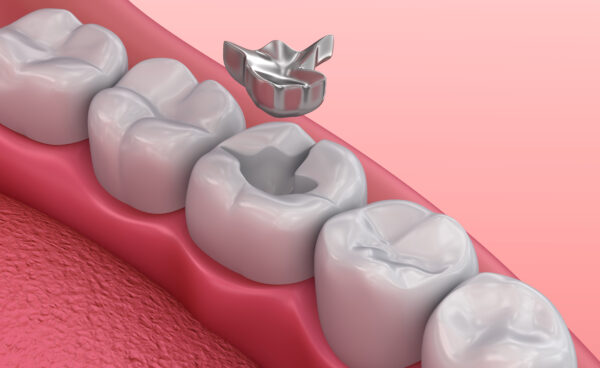 The Most Popular Types of Dental Fillings